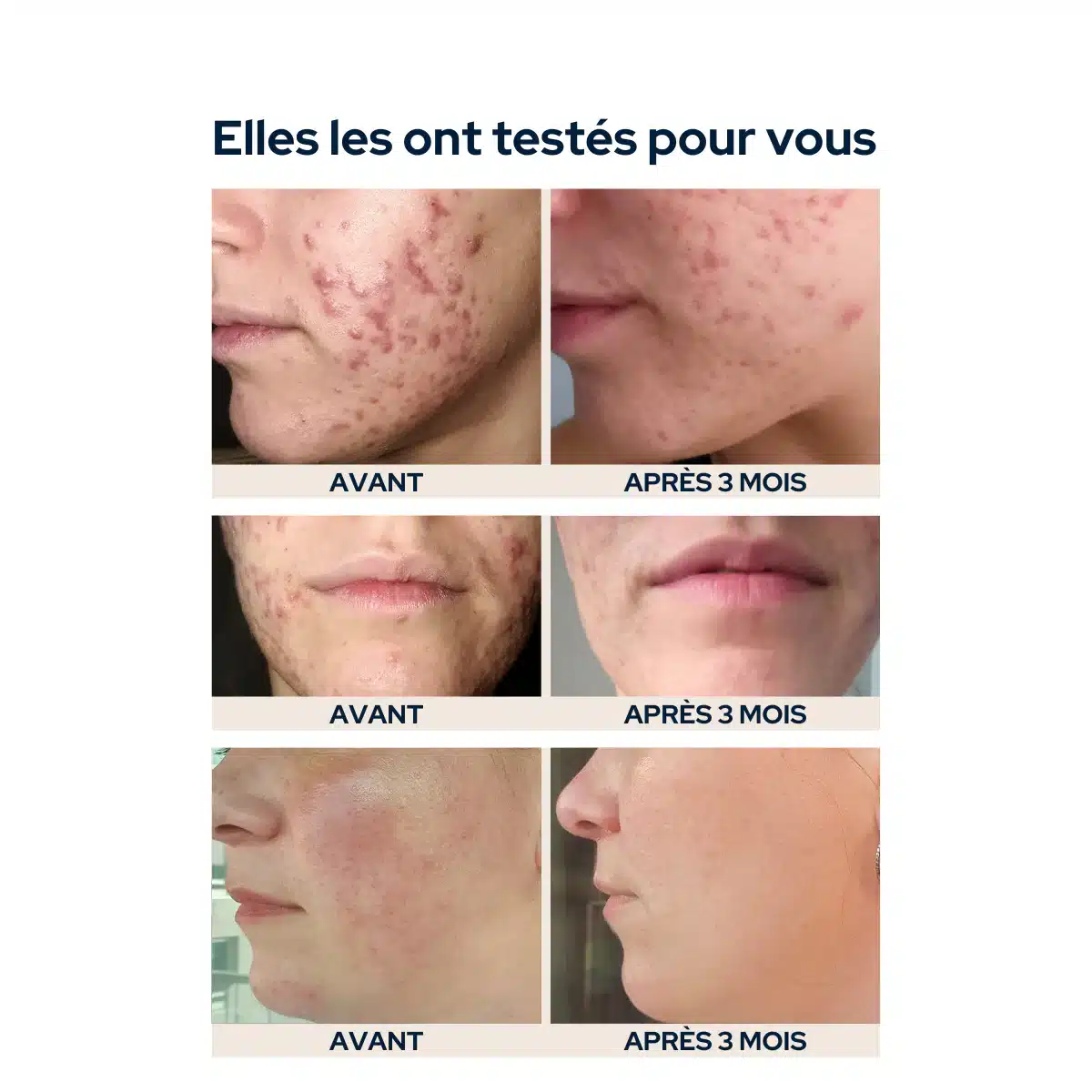 Caramelle Gommose Anti-imperfezioni - 1 Mese 60 gomme EPYCURE